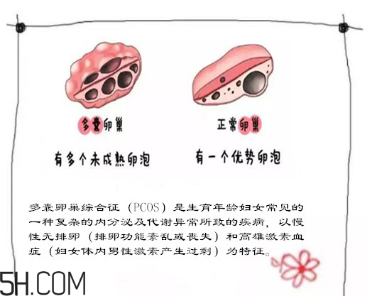 多囊卵巢生不了？多囊卵巢怀孕要看准时间