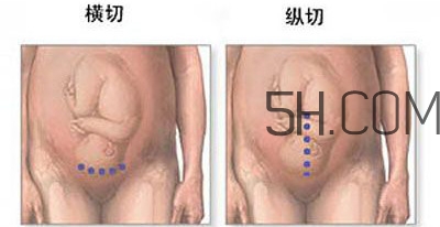 什么情况下需要剖腹产 剖腹产最全科普