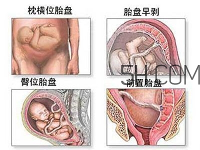 什么情况下需要剖腹产 剖腹产最全科普