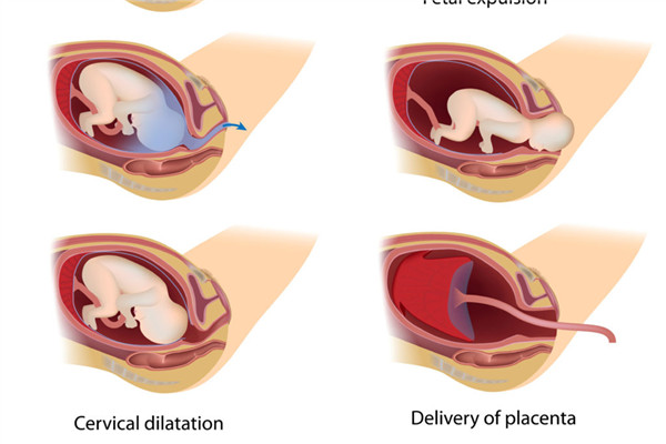分娩过程的顺序 全程疼痛剧烈