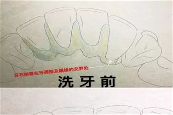 为什么洗牙有异物感 洗牙的误区